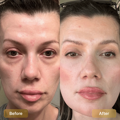 HeadShine™ Red Light Therapy & EMS Microcurrents For Eye Bags