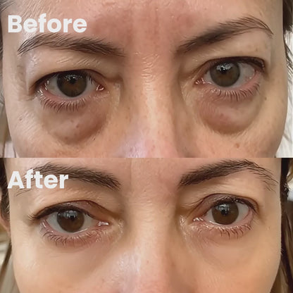 HeadShine™ Red Light Therapy & EMS Microcurrents For Eye Bags